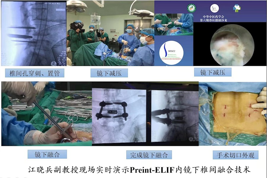 中医药学会脊柱微创专家委员会第六次脊柱微创沙龙和手术直播回顾